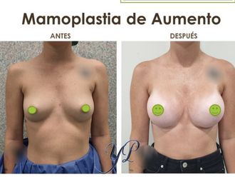 Aumento de pecho antes y después - 865284