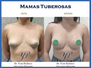 Reducción de senos - Dr. Yvan Pacheco