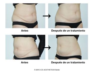 Antes y después abdominoplastia