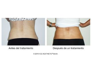 Antes y después Liposucción