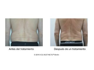 Antes y después Liposucción