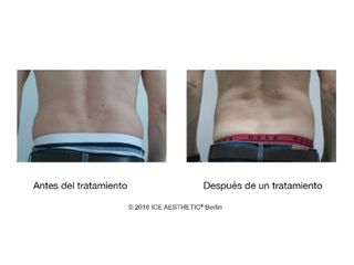 Antes y después Liposucción