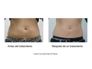 Antes y después Liposucción