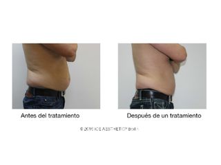 Antes y después Liposucción