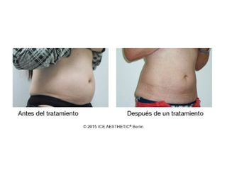 Antes y después Liposucción