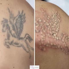 Eliminación de tatuaje - Quiroderma