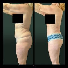 Lipo Vaser - Quiroderma