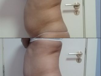 HIFU antes y después - 842518