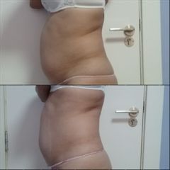 Reducción de abdomen sin cirugía Ultrasonix - MiLena
