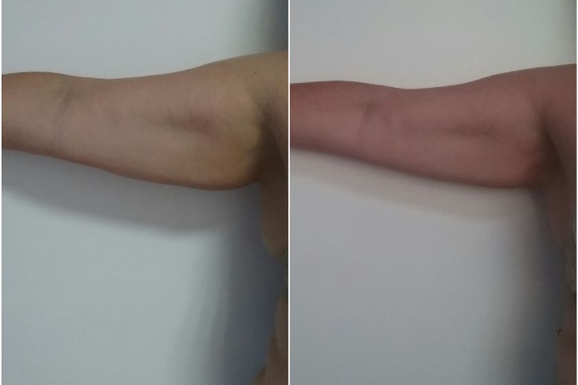 HIFU antes y después - 842519