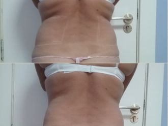 HIFU antes y después - 842522