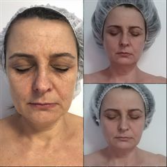 Lifting facial Ultrasonix sin cirugía - MiLena