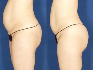 Velashape III antes despues