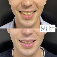 Aumento de labios - Dr. Sebastián Ríos