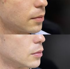 Aumento de labios - Dr. Sebastián Ríos