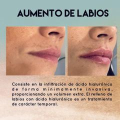 Antes y después Aumento de labios - Saona Clínicas De Estética