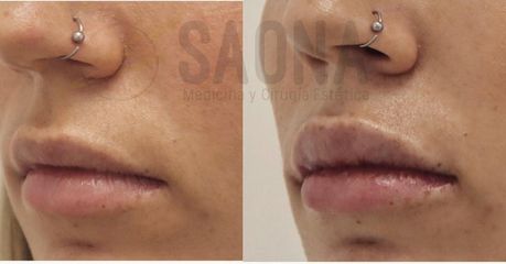Antes y después Aumento de labios - Saona Clínicas De Estética