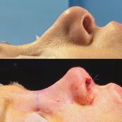Antes y después Rinoplastia - Saona Clínicas De Estética