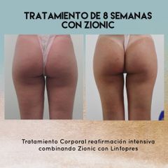Antes y después Celulitis - Saona Clínicas De Estética