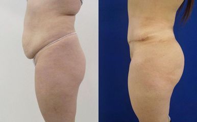 Antes y después Abdominoplastia - Saona Clínicas De Estética