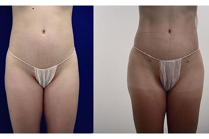 Mesoterapia antes y después - 737946