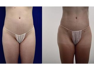 Antes y después Mesoterapia - Saona Clínicas De Estética