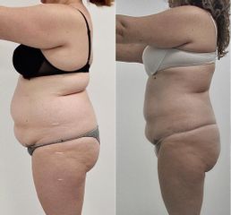 Antes y después Criolipolisis - Saona Clínicas De Estética