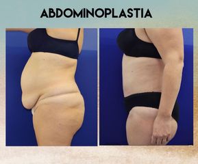 Antes y después Abdominoplastia - Saona Clínicas De Estética