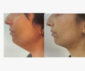 Antes y después Liposucción de papada - Saona Clínicas De Estética