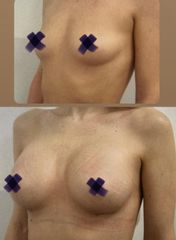 Antes y después Aumento de pecho - Saona Clínicas De Estética
