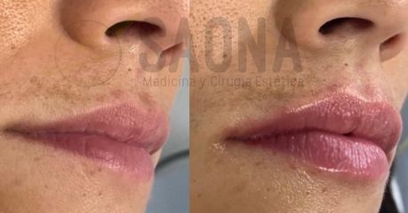 Aumento de labios - Saona Clínicas De Estética