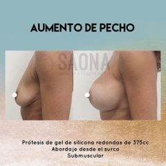 Aumento de pecho - Saona Clínicas De Estética