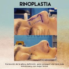 Rinoplastia - Saona Clínicas De Estética