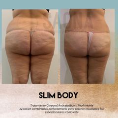 Celulitis - Saona Clínicas De Estética