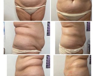 Presoterapia antes y después - 814242