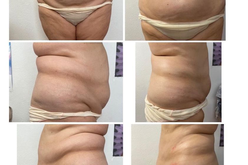 Presoterapia antes y después - 814242