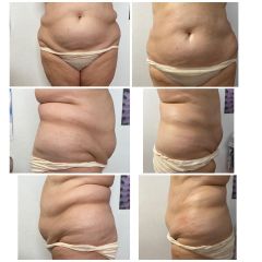 Presoterapia - Centro Gema Corral