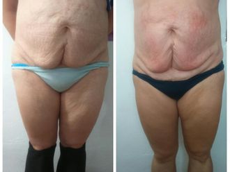 Presoterapia antes y después - 814992