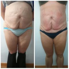 Presoterapia - Centro Gema Corral