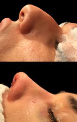 Antes y después Rinoplastia