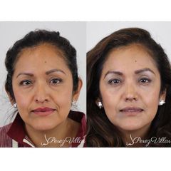 Rinoplastia - Dr. Pérez Villar