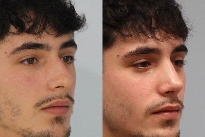 Rinoplastia antes y después - 878018