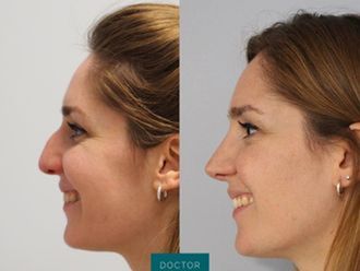 Rinoplastia antes y después - 879100