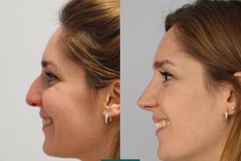 Rinoplastia antes y después - 879100