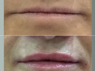 Aumento labios antes y después - 878487
