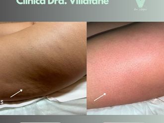 Celulitis antes y después - 878488