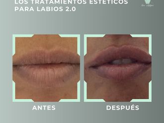 Aumento labios antes y después - 878840