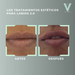 Aumento de labios - Clínica Doctora Villafañe