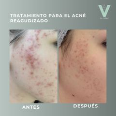 Tratamiento antiacné - Clínica Doctora Villafañe