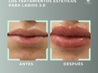 Aumento labios antes y después - 878842